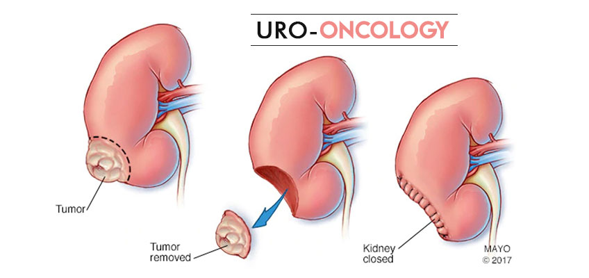 Uro Oncology Treatment In Jaipur